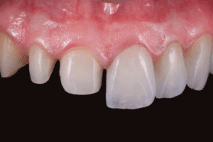 Sorriso com dentes tratados por odontologia minimamente invasiva