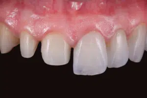 Sorriso com dentes tratados por odontologia minimamente invasiva