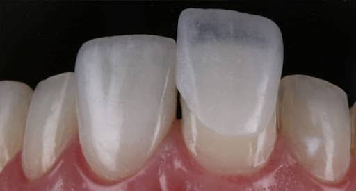 Imagem ilustrativa de facetas dentárias sendo aplicadas em dente anterior – tratamento estético procurado no Tatuapé.